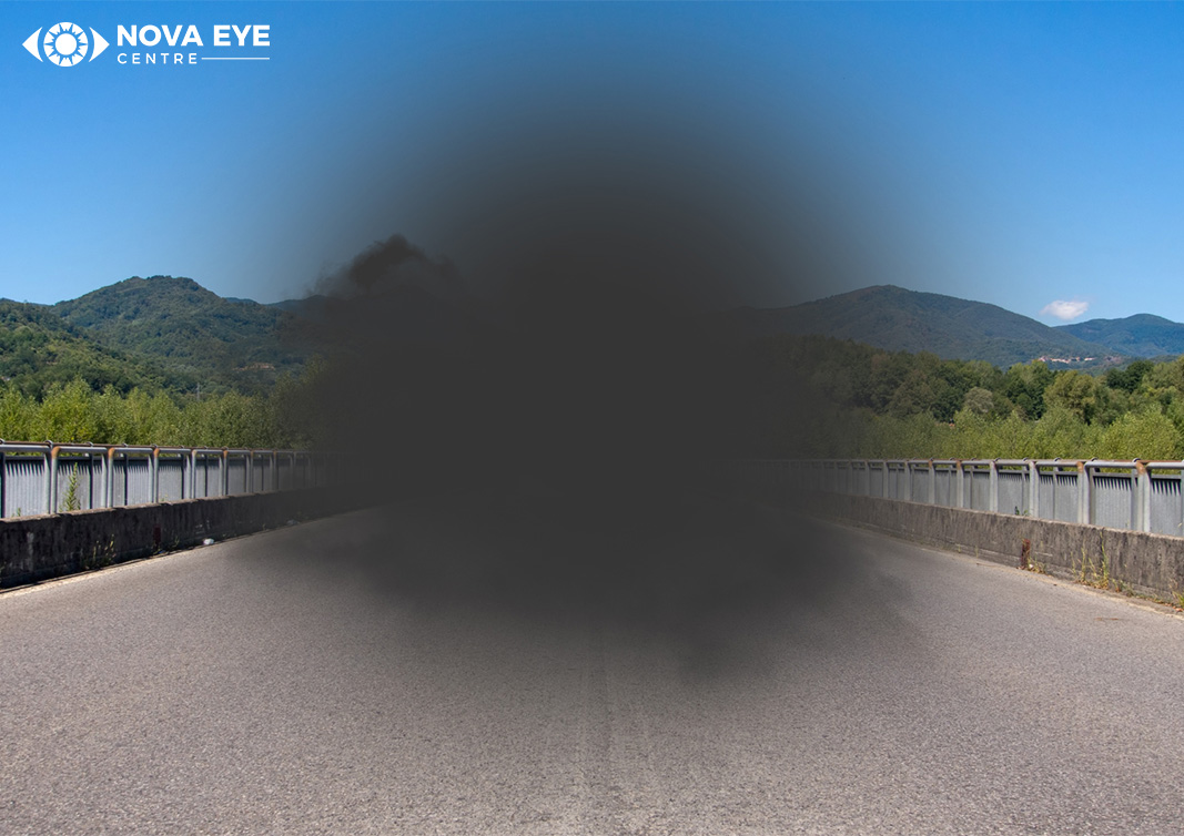 Understanding Age-Related Macular Degeneration: Causes, Symptoms, And ...