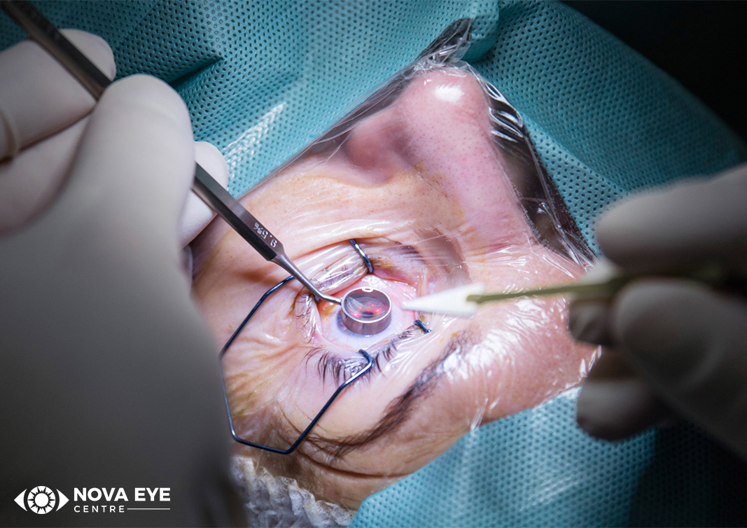 LASIK vision correction procedure