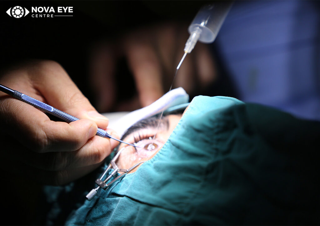 A close-up of a surgical procedure being performed on a patient's eye with specialized medical instruments under bright light.