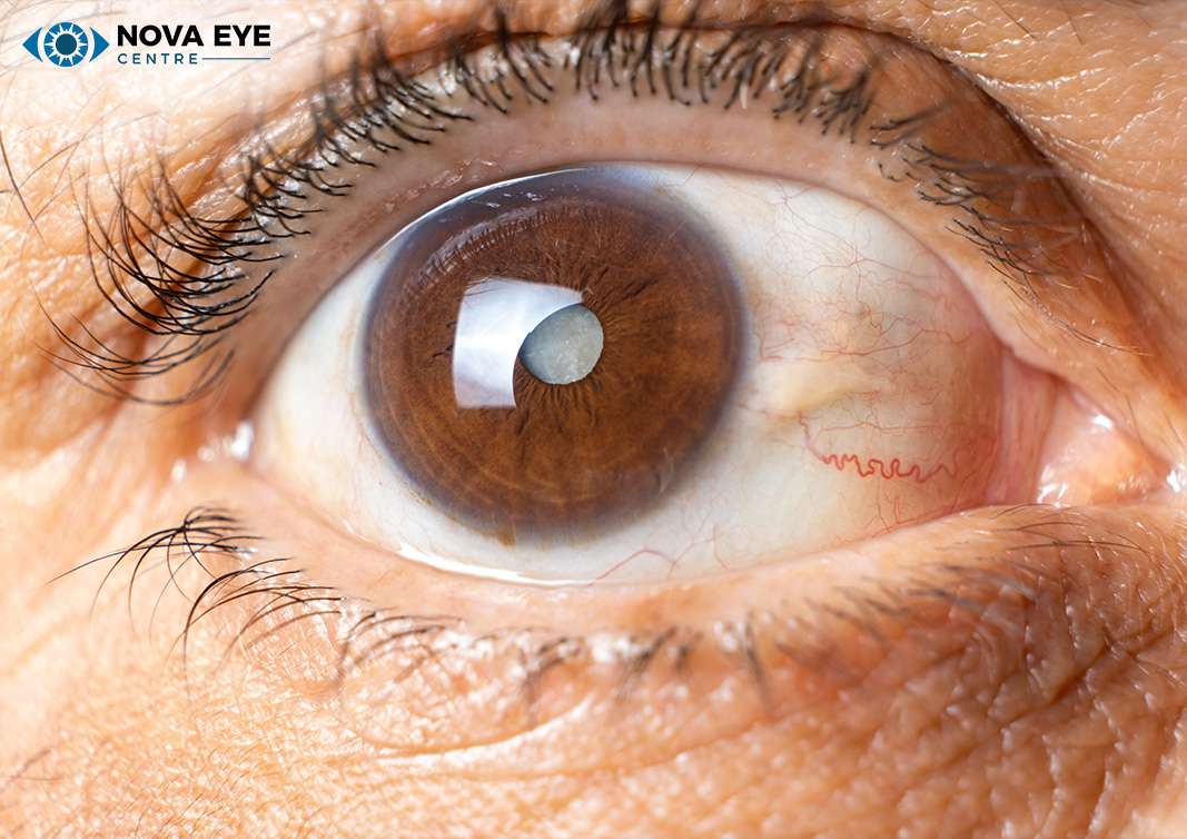 Eye of an elderly man with cataracts