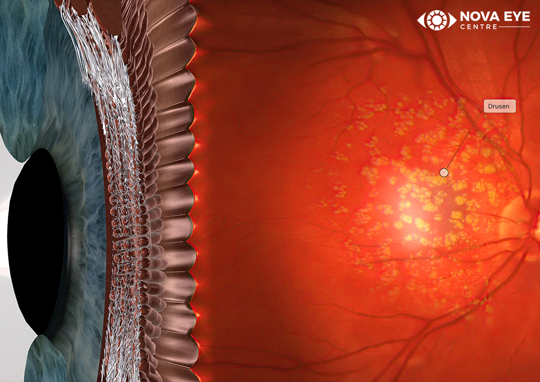 Eye’s retina showing drusen deposits highlighted on the macula, with a cross-sectional view of retinal layers beside a retinal surface view.